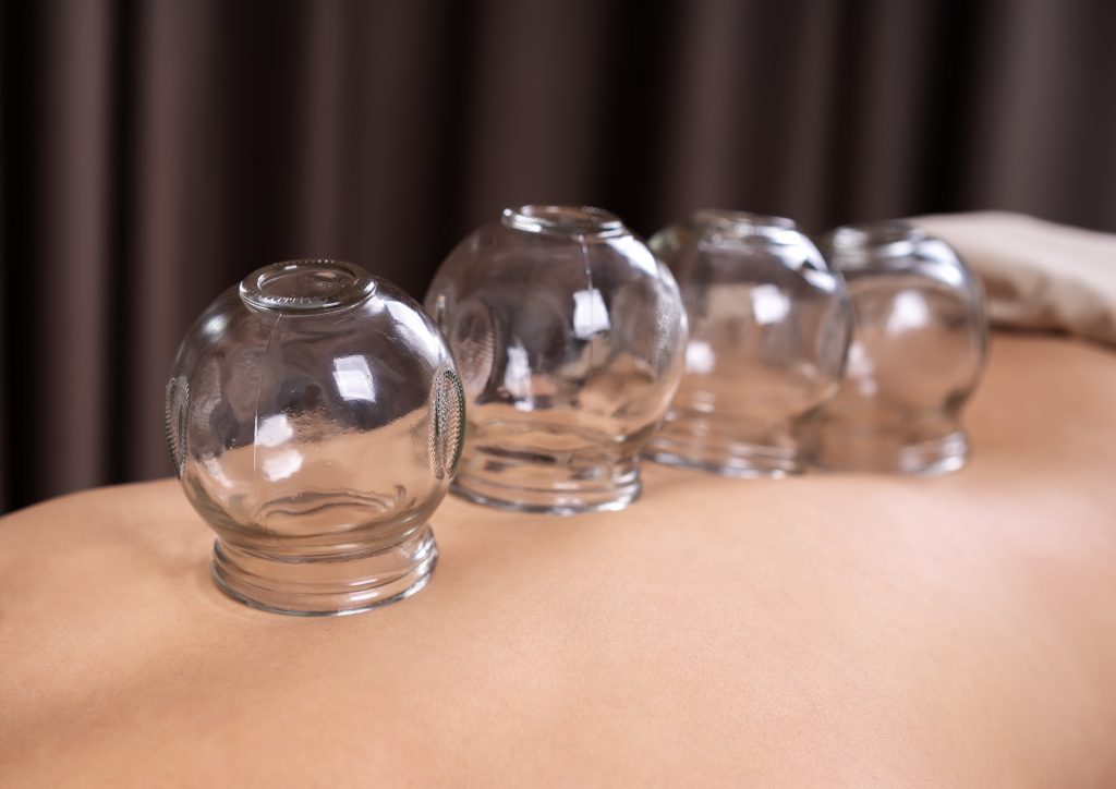 young,woman,receiving,cupping,treatment,on,back