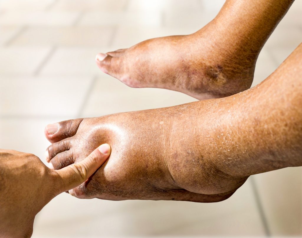 close up,of,an,older,asian,person,with,swollen,feet,,leg